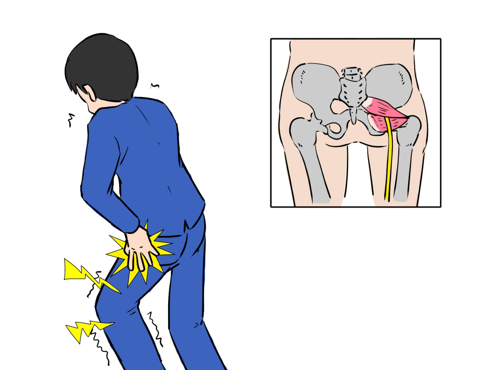 坐骨神経痛の症状を示すイラスト（腰楽院オアシス）